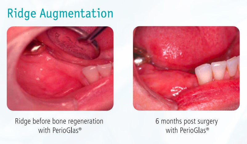 Novabone Perioglas (1 x 0.5cc)