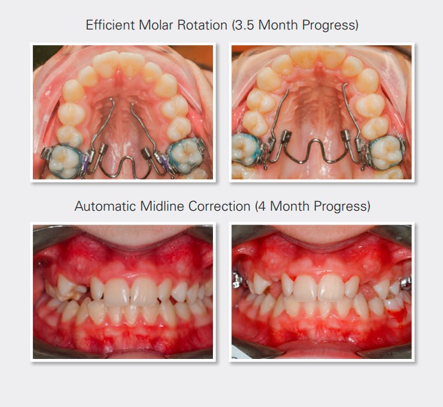 Ortho Organizers Nitanium Palatal Expander 2 Appliance