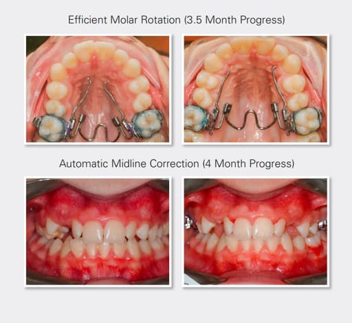 Ortho Organizers Nitanium Palatal Expander 2 Appliance