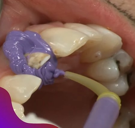 ET Dental Intra Oral Tips