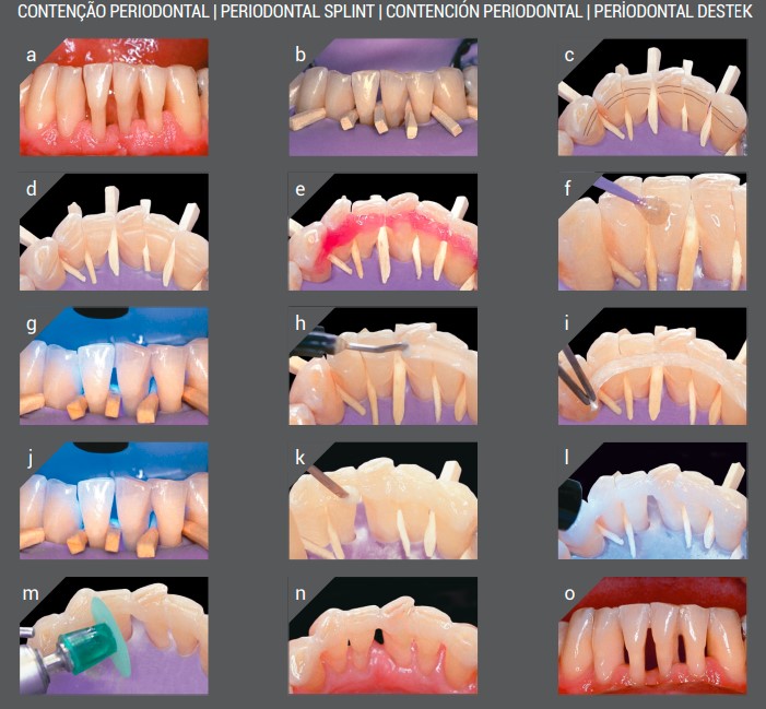 Angelus Interlig Single Patient Strip
