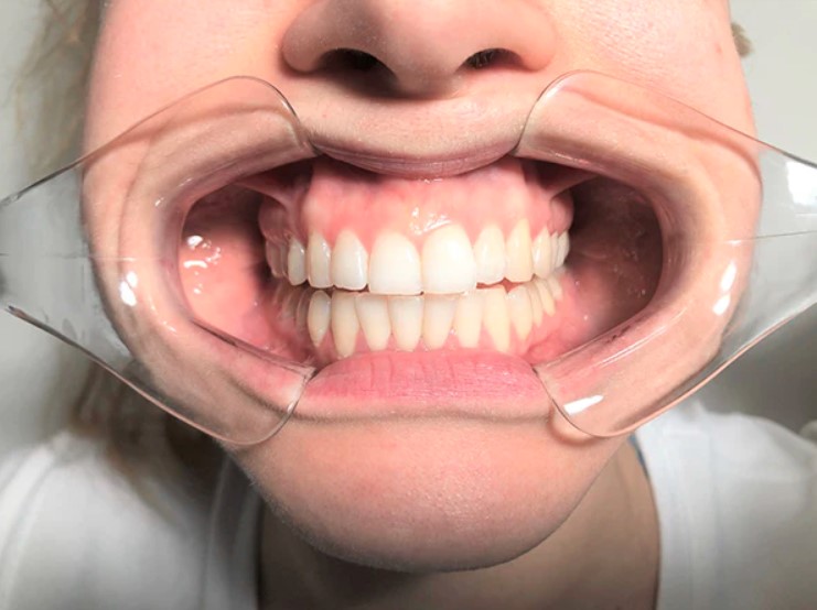 ET Dental Cheek Retractor Y Type (premium)	