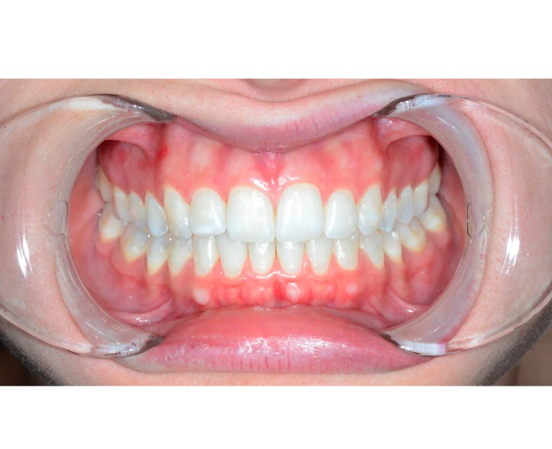 ET Dental Double Sided Cheek Retractor 