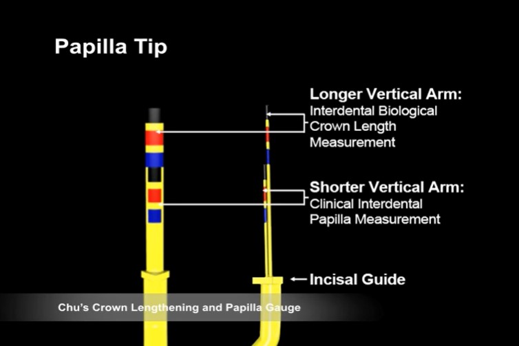 Hu-Friedy Chu'S Crown Lengthening Gauge (CLG)
