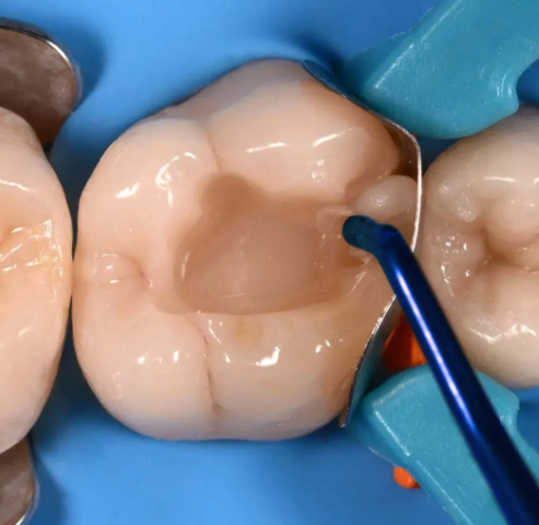 Oracraft Composite Instrument Blue Titanium Set Of 6 In Pouch - CIBS6