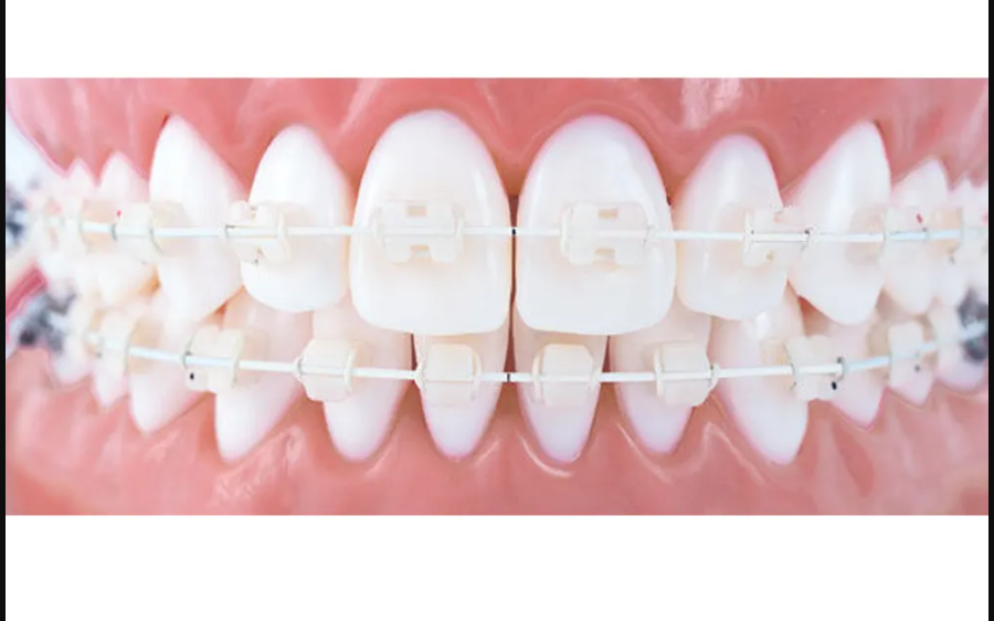 U Ortho Niti Tooth Color Wire - Ovoid (Pack of 1)