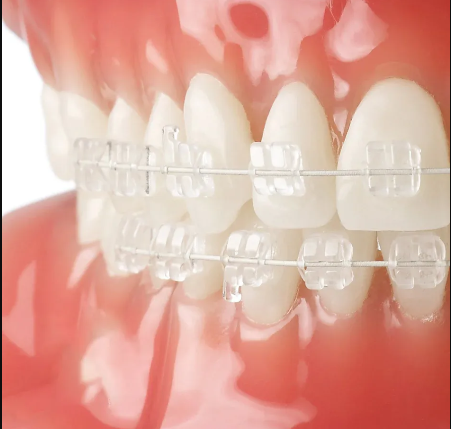 U Ortho Niti Tooth Color Wire - Ovoid (Pack of 1)