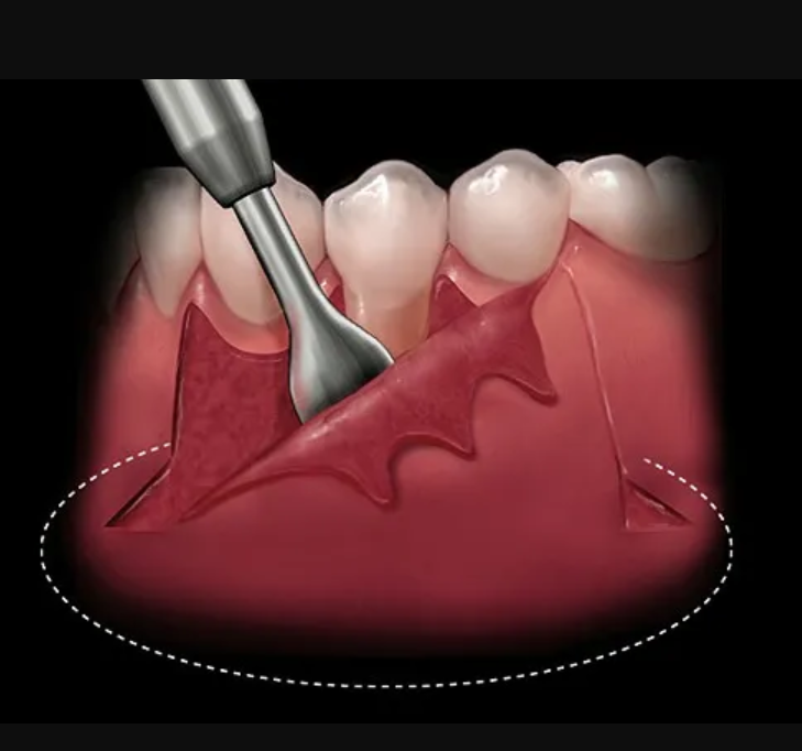 GI Dental Periosteal Elevator Molt (Large)
