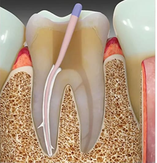 Dentsply Ah Plus Root Canal Sealant
