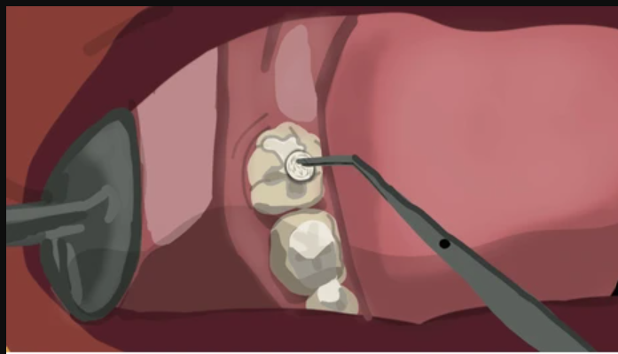 Kulzer Charisma Smart Composite 4g Syringe Refill 