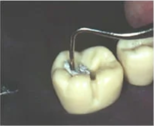 GI Dental Round Condenser