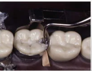 GI Dental Round Condenser