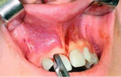 RMC Sterile BP Surgical Blades (Pack of 100)     