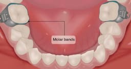 U Ortho Molar Bands Non-Convertible Mbt 0.022 2nd Molar (Pack of 4) - 7