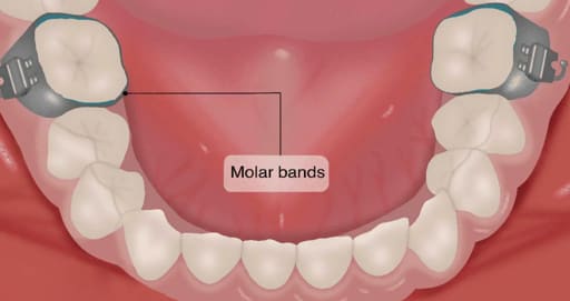 U Ortho Molar Bands Non-Convertible Mbt 0.022 2nd Molar (Pack of 4)