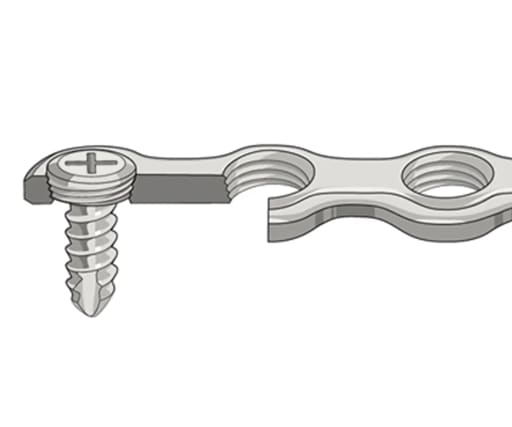 SK Surgicals SS Single Slot Screws - 2mm (Pack of 5)