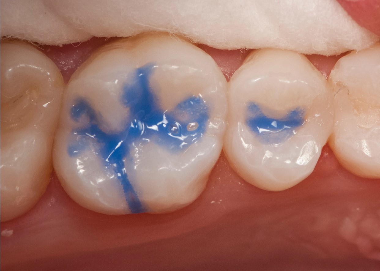 Waldent Porcelain Etch     