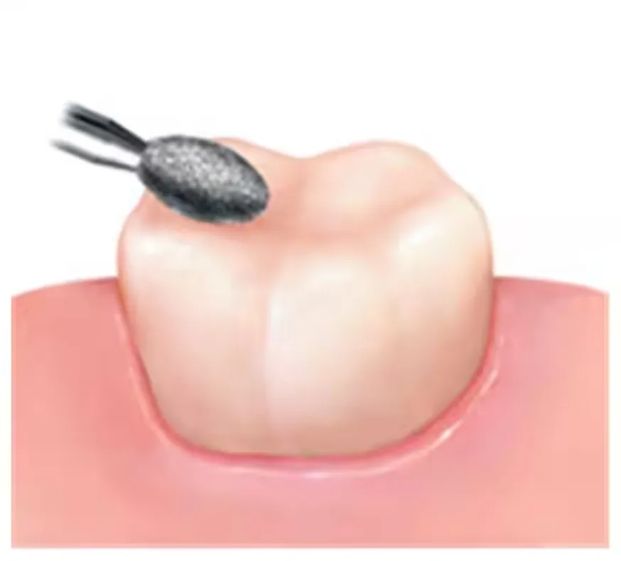 Frank Dental Flame Ogival FG Diamond Burs FO Series (Coarse)