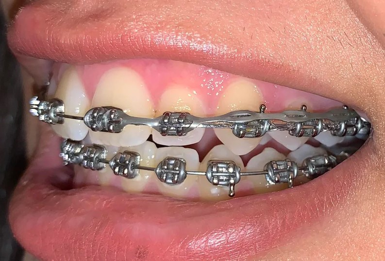 U Ortho E-Chain (15 ft) - Long Grey
