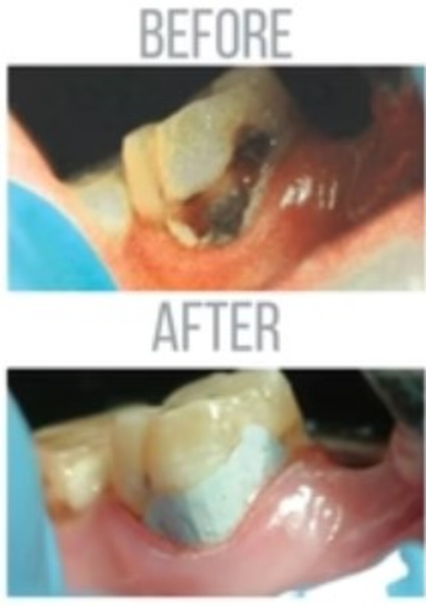 Ammdent GI Silver Reinforced Restorative Cement