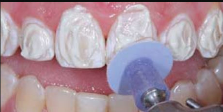 Septodont Detartrine