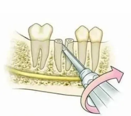 GDC Root Elevators Root Tip Pick Heidbrink - Straight (Ehb1)