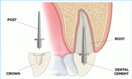 Angelus Reforpost Metallic Refill