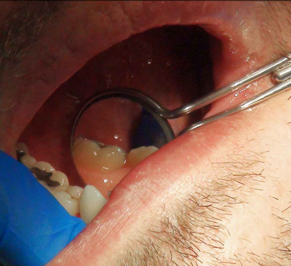 Waldent Rhodium Coated Mouth Mirror Tops (Pack of 1)