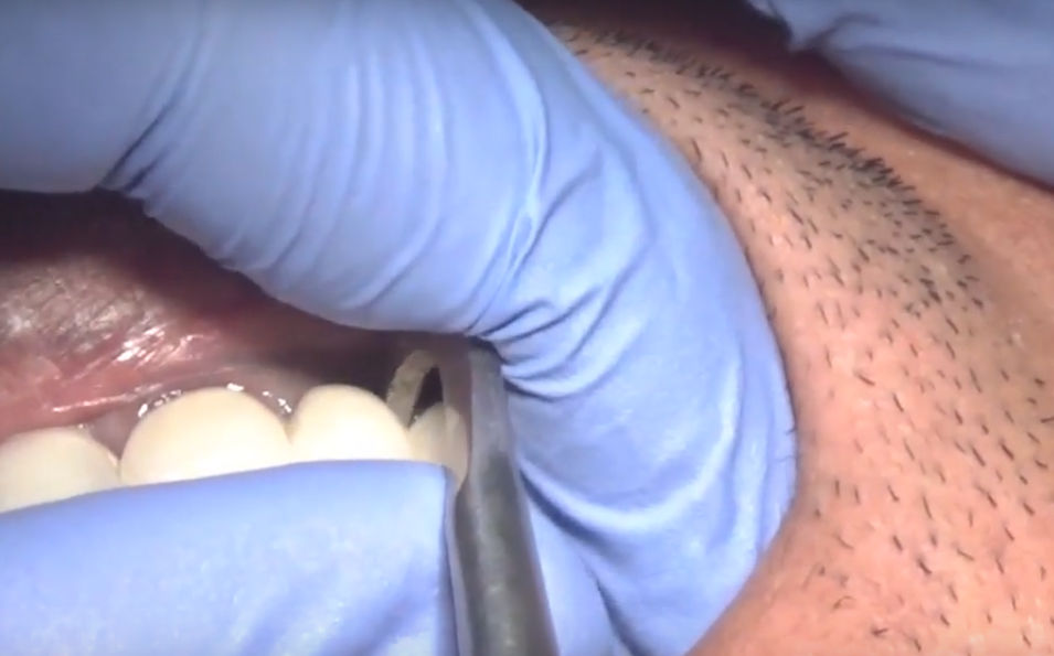 Waldent Crown Remover Tips