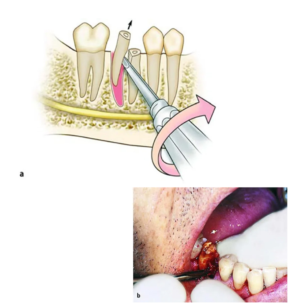Waldent Miller Apexo Root Elevators