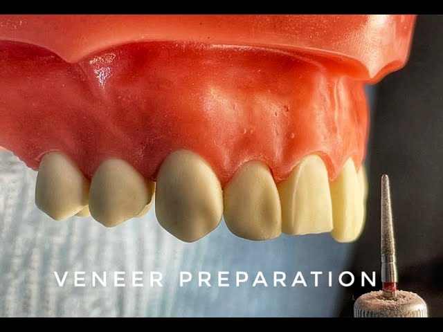 Shofu Porcelain Veneer Kit