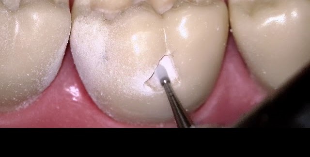 Mani Diamond Burs - Children'S Densitry / Cd Series