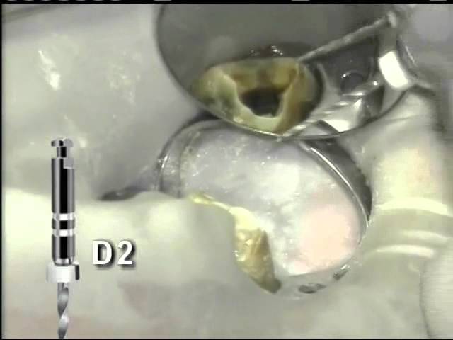 Dentsply Protaper Universal Retreatment Rotary Files