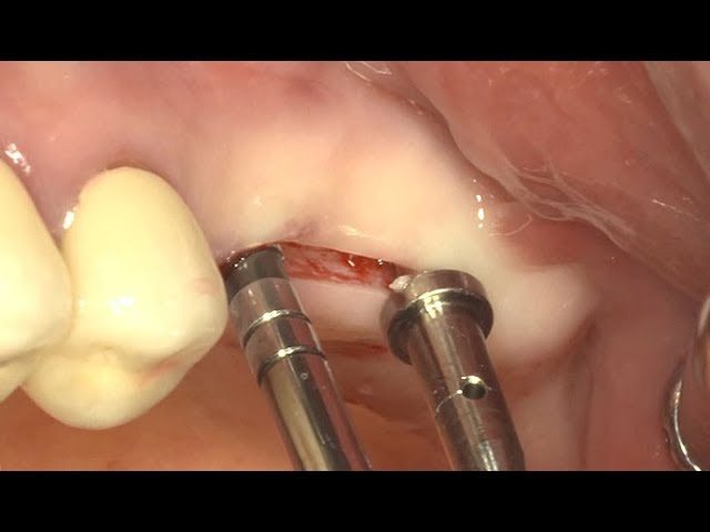 Api+ Osteotomes Convex With Stoppers 
