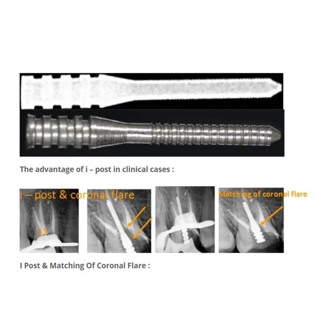 Prime Dental i Post Endodontic Metal Post Refills