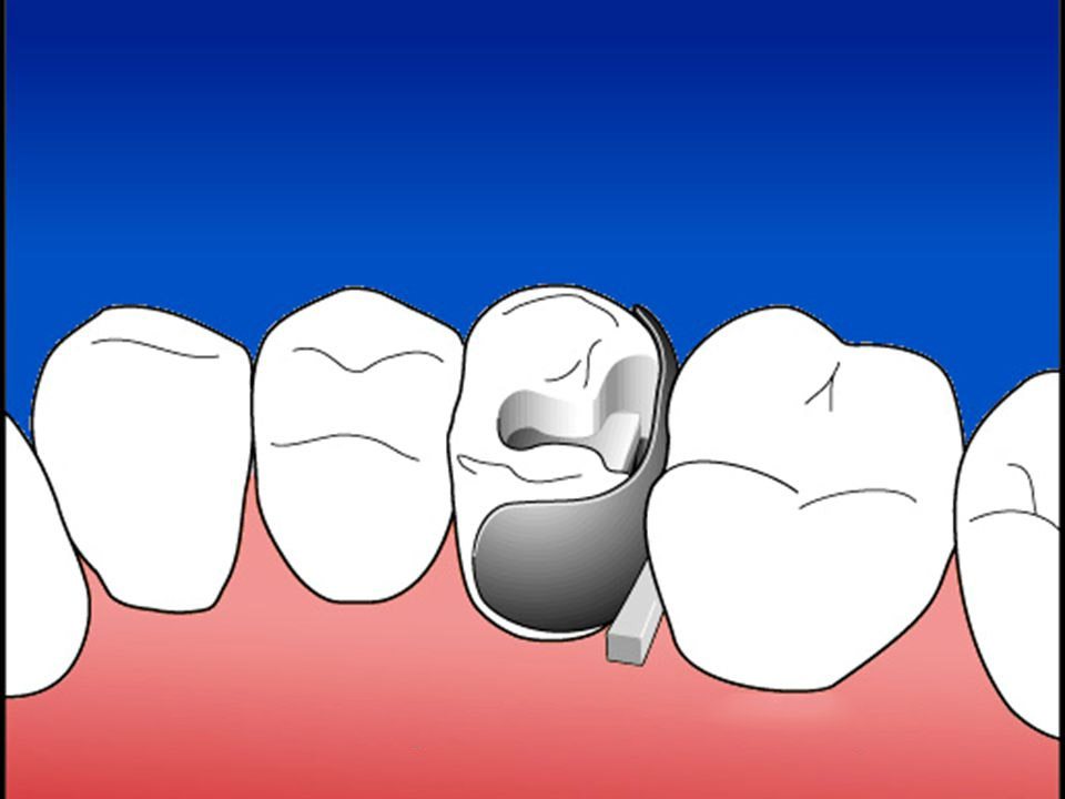 ET Dental Sectional Contoured Matrices Refill