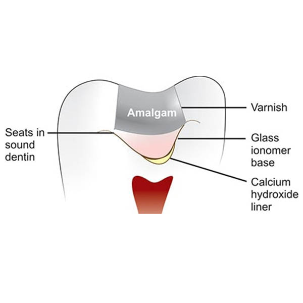 GC Fuji Varnish (5gm)