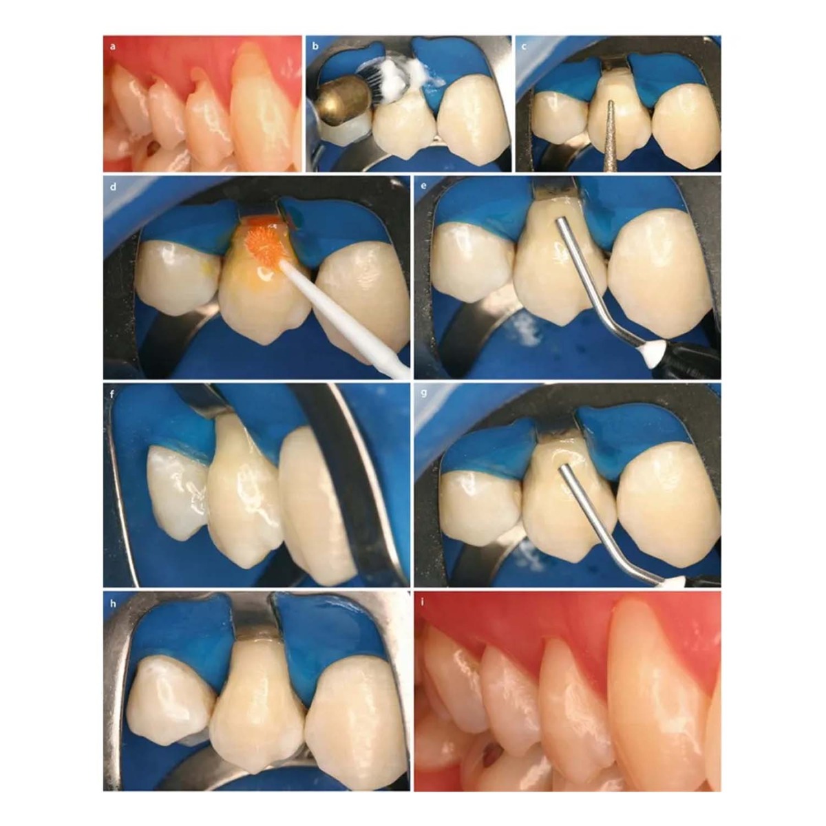 Prime Dental Restorite Flow Viscous Composite