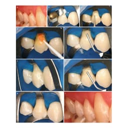 Prime Dental Restorite Flow Viscous Composite - 5