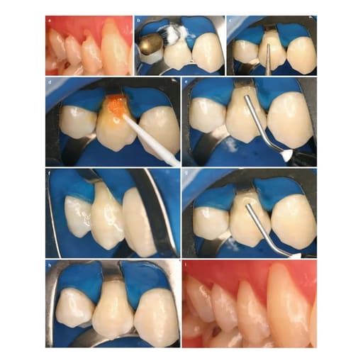 Prime Dental Restorite Flow Viscous Composite