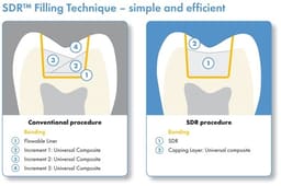 Dentsply SDR Plus Flowable Bulk Filling Material  - 10