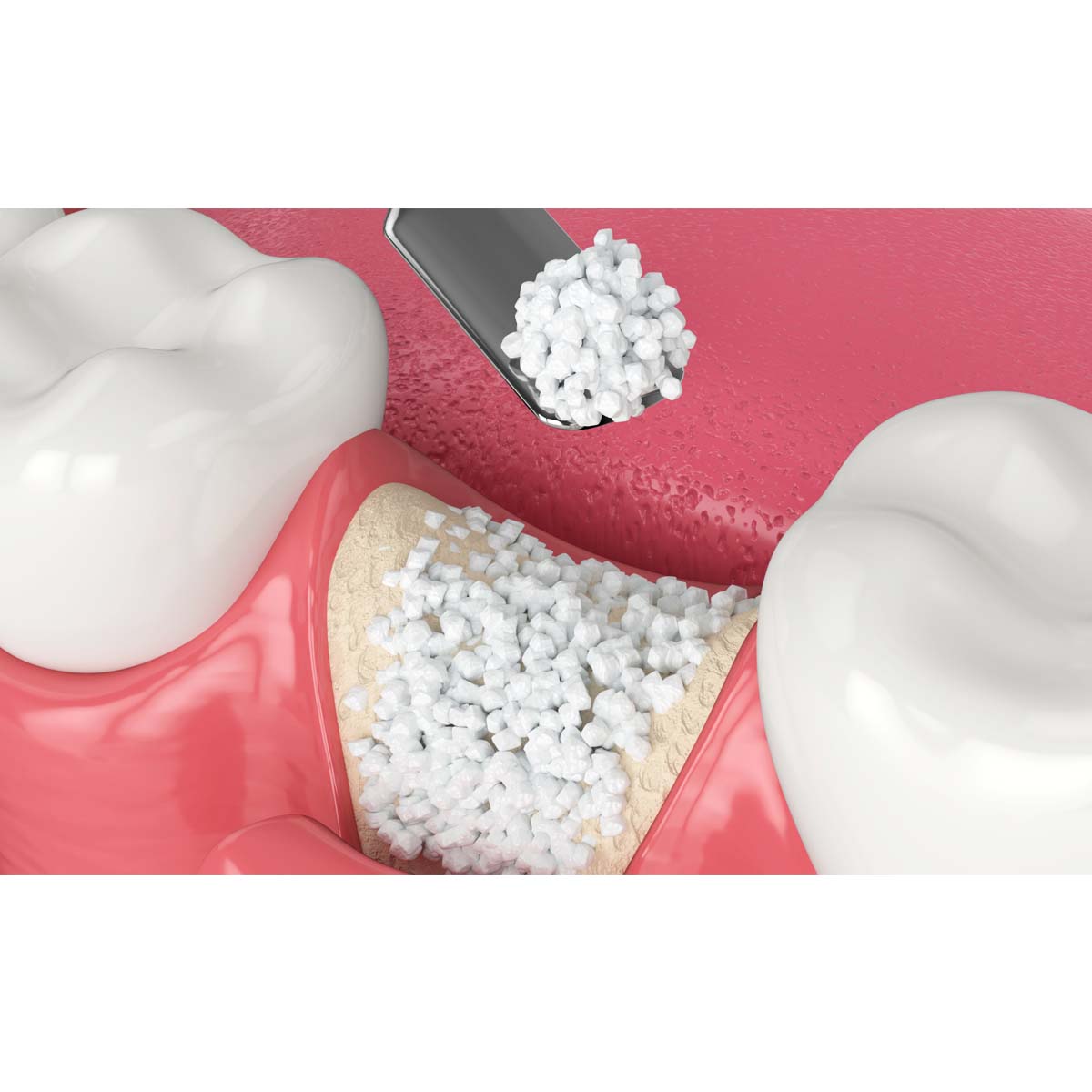 Ammdent Ostoden Bone Graft Material 0.5cc