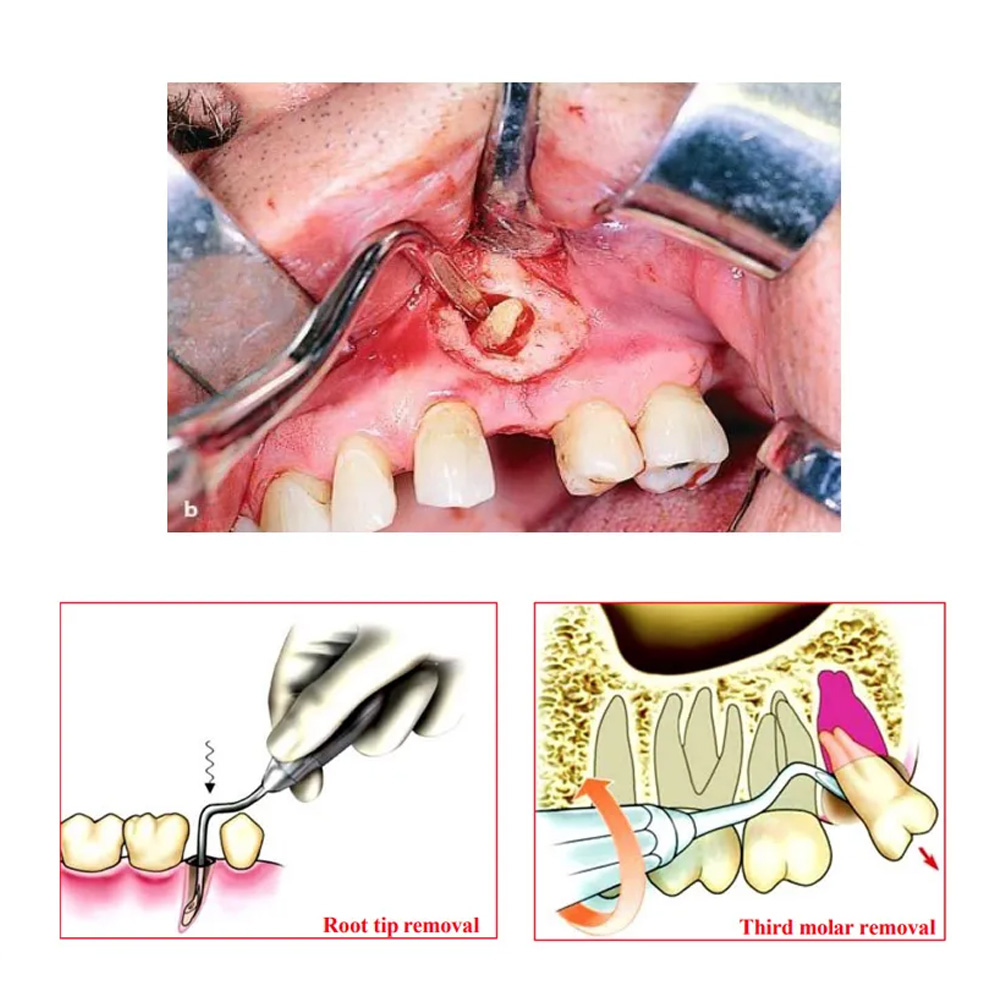 Waldent Flohr Root Elevators
