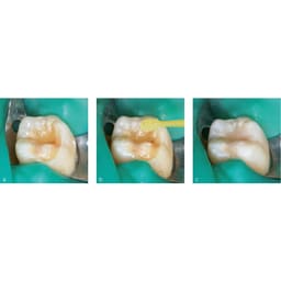 Prime Dental Restorite Cavo Surface Sealer - 3