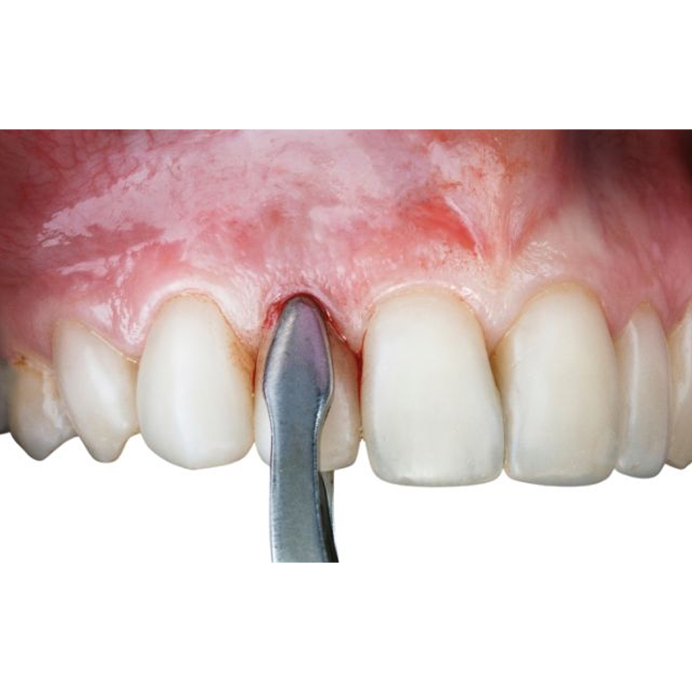 GDC Extraction Forceps Upper Roots - 944.01 Secure (Sfx944.01)
