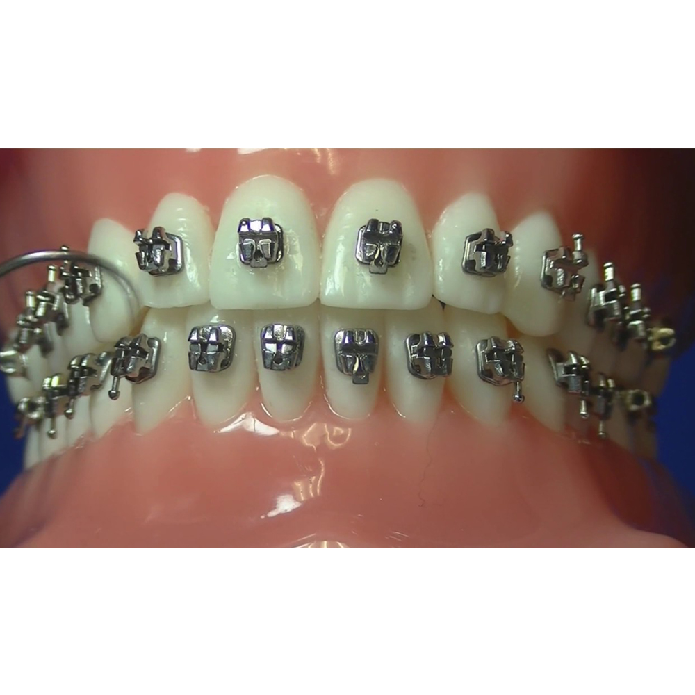 Phyx Streak Metal Self Ligating Brackets