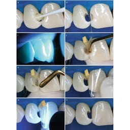 GDC Composite Instrument Gold Titanium Set Of 6 (CIGP6) #6 - 6