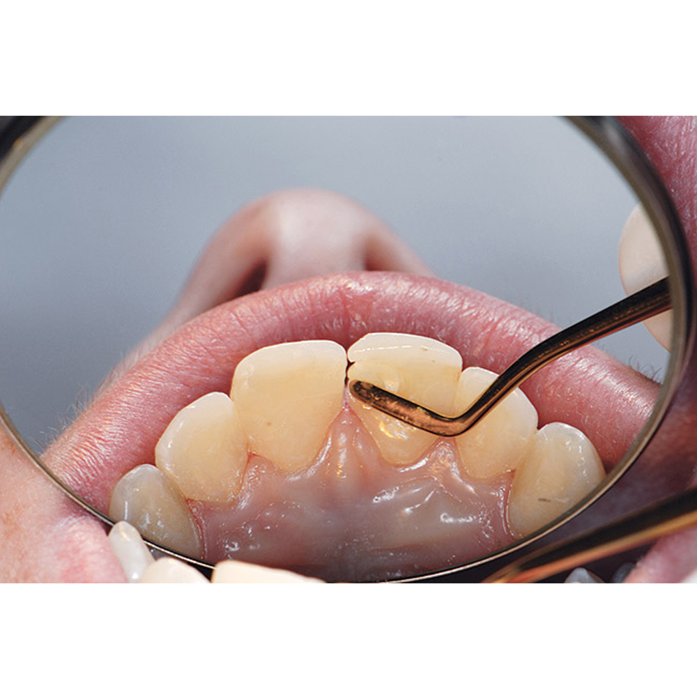 GDC Composite Instrument Flexi Thin Gold Titanium - 6 (CIGFT1)