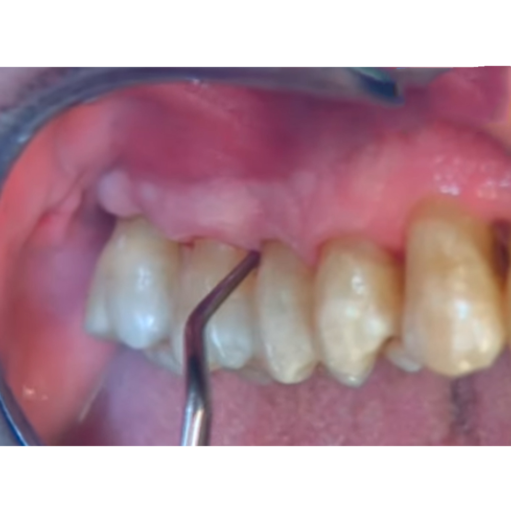 GDC Gracey Curettes Cc Mesial Surfaces Of Posterior Teeth # 7 (Sgcc11/12)
