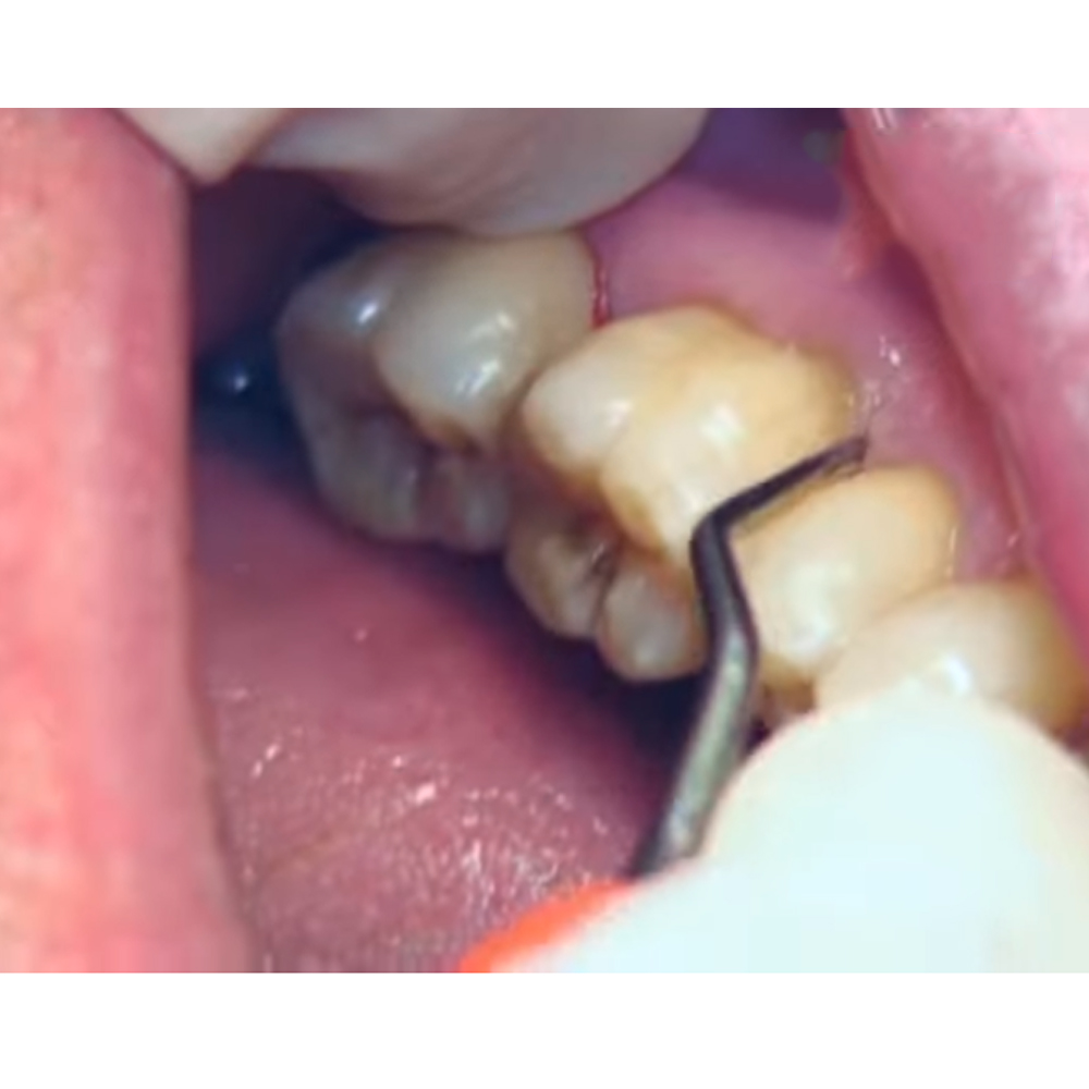 GDC Gracey Curettes Cc Mesial Surfaces Of Posterior Teeth # 7 (Sgcc11/12)